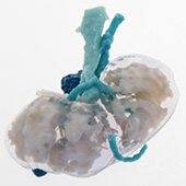 3D-printed organs are saving cancer patient's lives